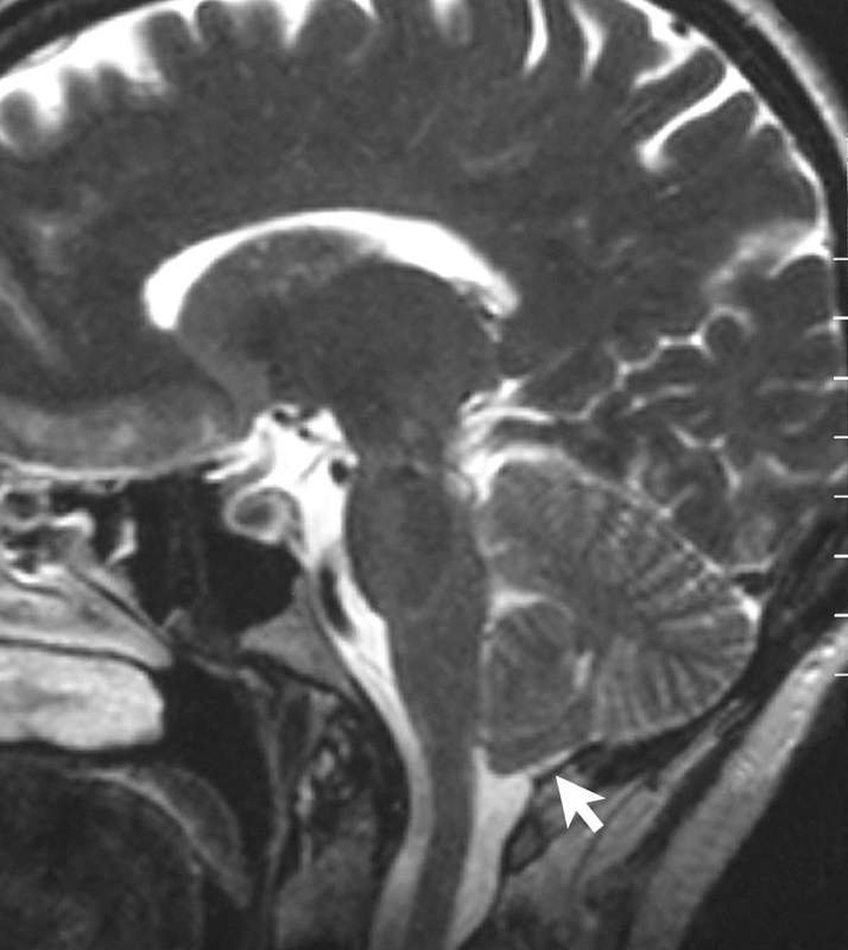 ADHD linked to fourfold dementia risk in Pitt study of 187,000 adults