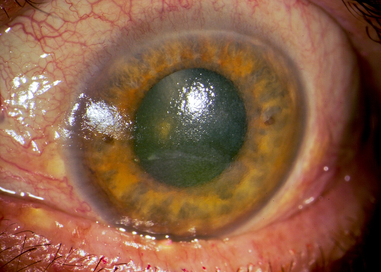 Why Do My Eyes Feel Dry and Gritty in the Morning?